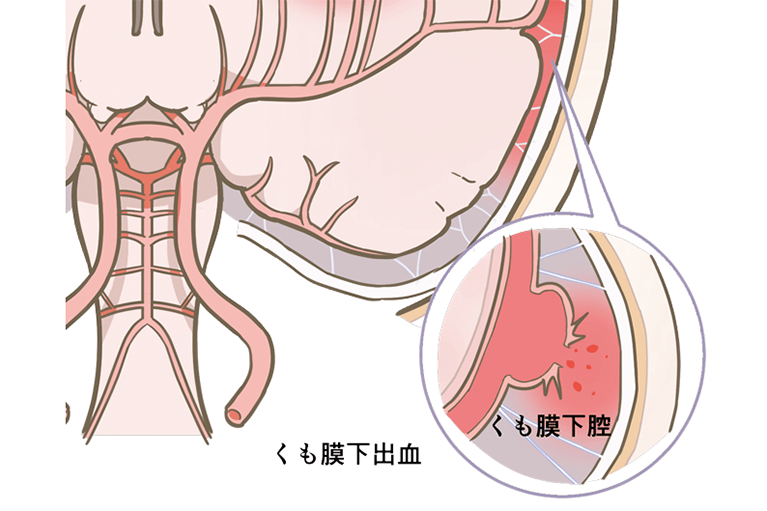 くも膜下出血