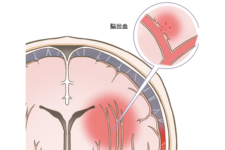 脳出血