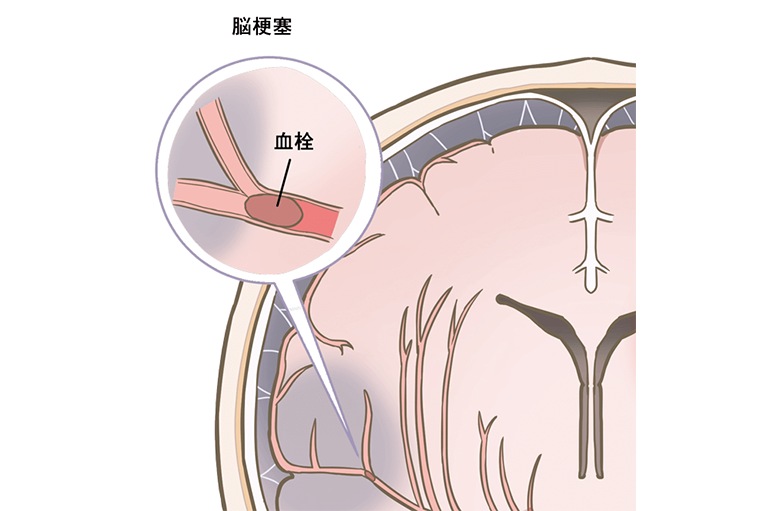 貧血 頭痛 い