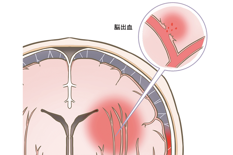 脳出血