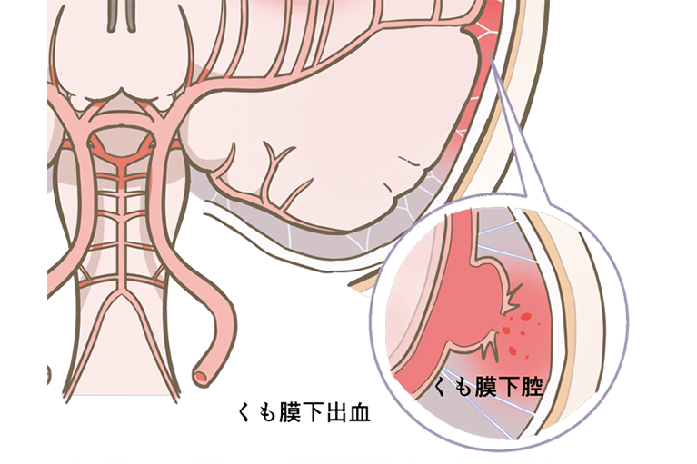 くも膜下出血